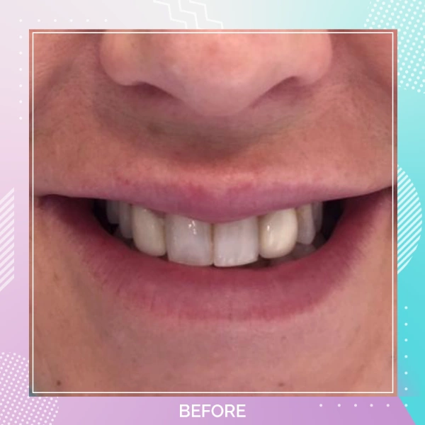Dental Veneers patient 3 B 1