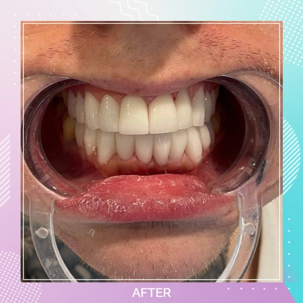 Dental Veneers patient 4 A Hollywood smile
