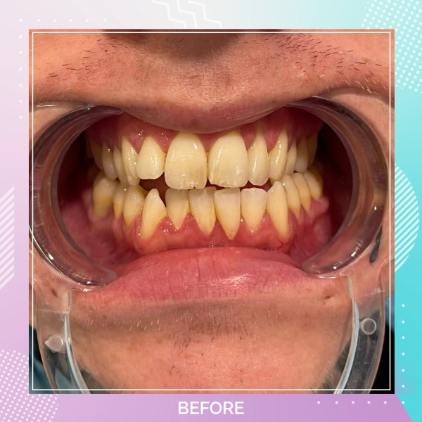 Dental Veneers patient 4 B Hollywood Smile