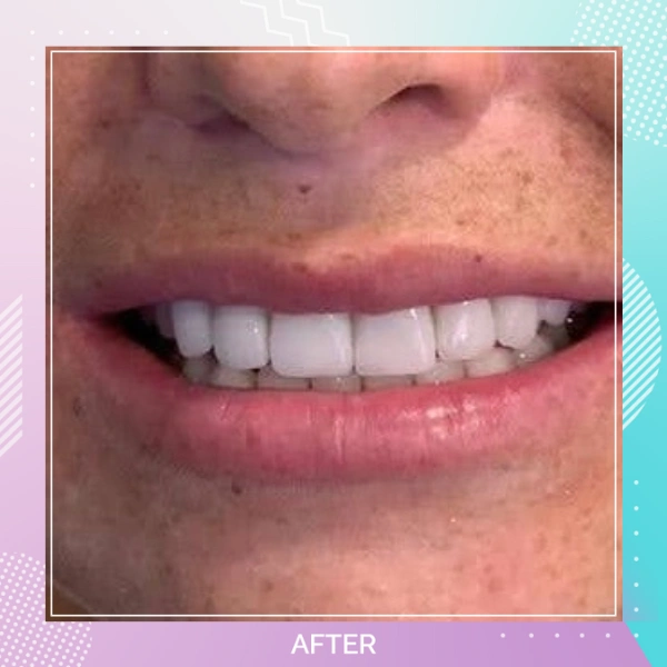 Dental Veneers patient 5 A Hollywood Smile