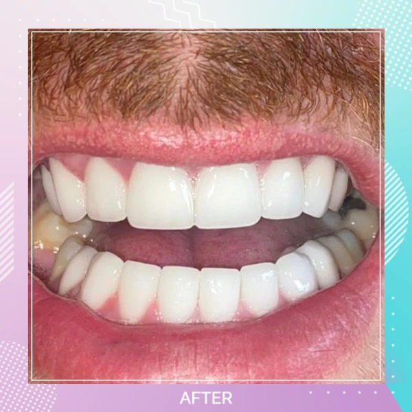 Dental Veneers patient 7 A 1