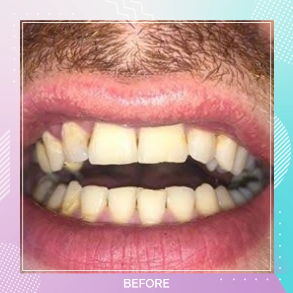Dental Veneers patient 7 B 1