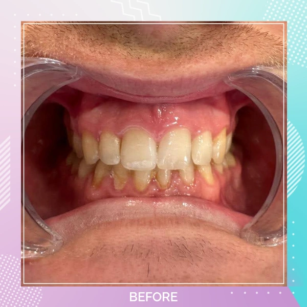 Dental Veneers patient 8 B 2