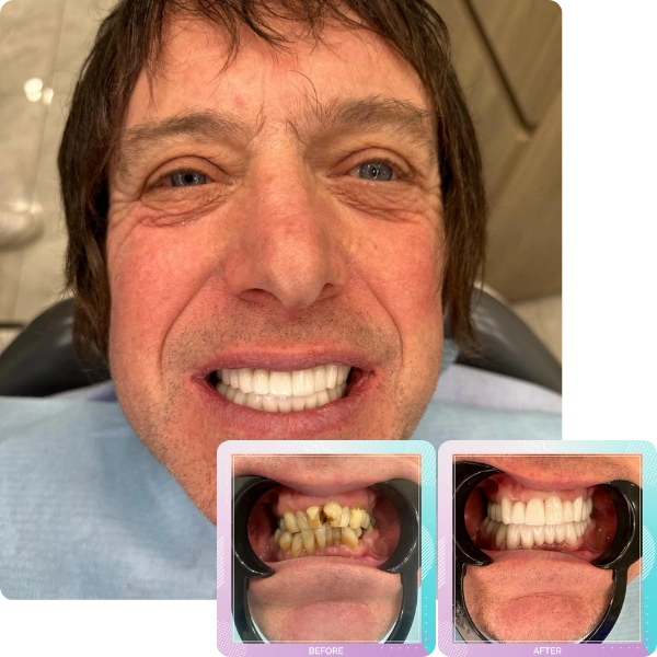 Smile gallery patient 9