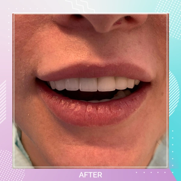 Teeth Whitening patient 1 A 1