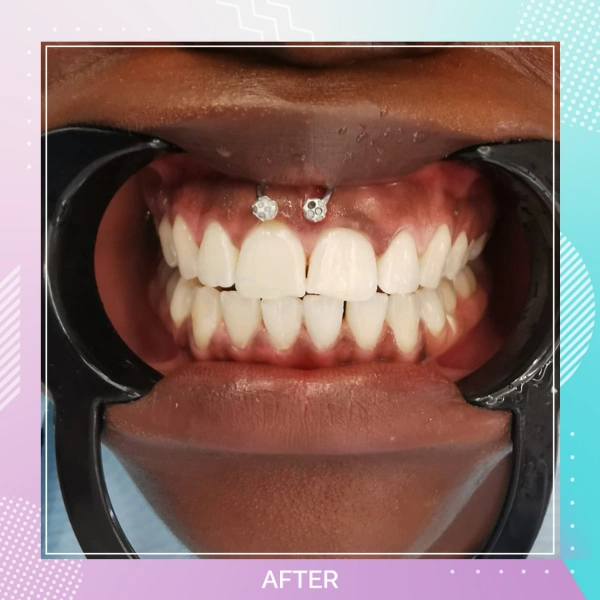 Teeth Whitening patient 2 A 1