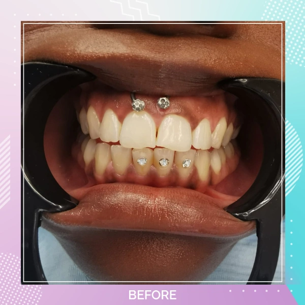 Teeth Whitening patient 2 B 1