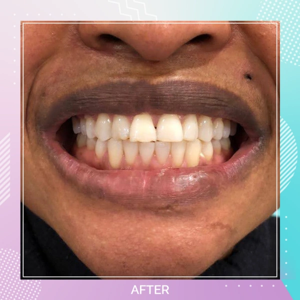 Teeth Whitening patient 3 A 1