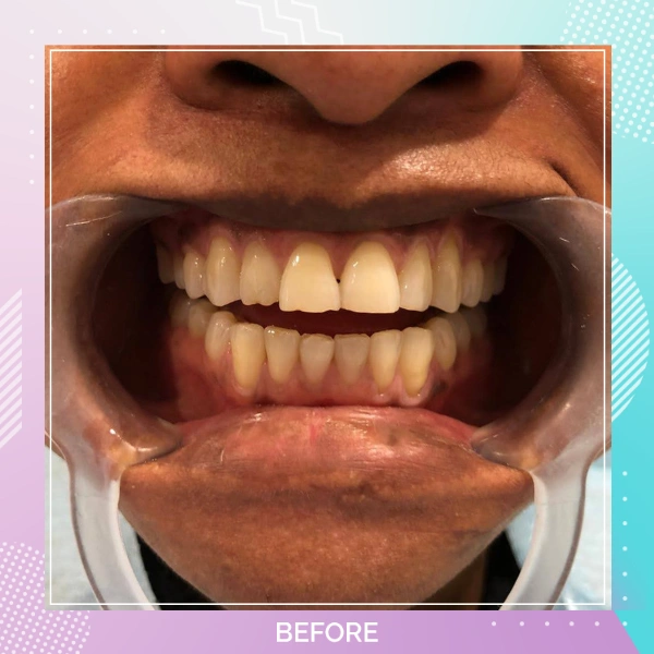 Teeth Whitening patient 3 B 1
