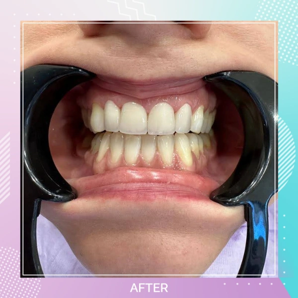 Teeth Whitening patient 4 A 1