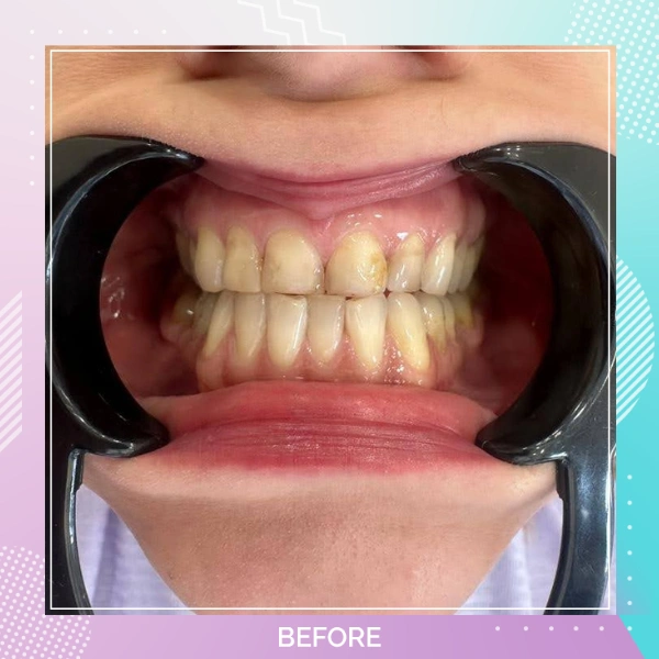 Teeth Whitening patient 4 B 1