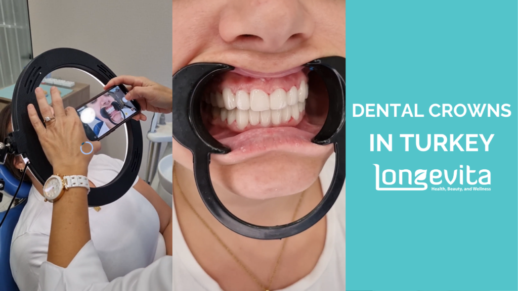 Dental crowns tranformation of Victoria