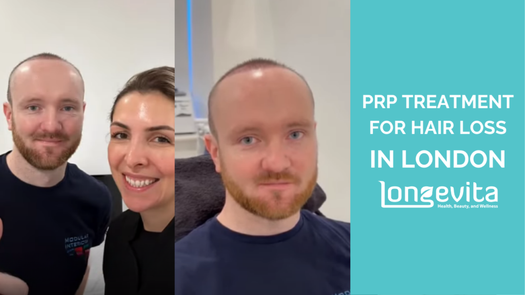 PRP Treatment for Hair Loss In London